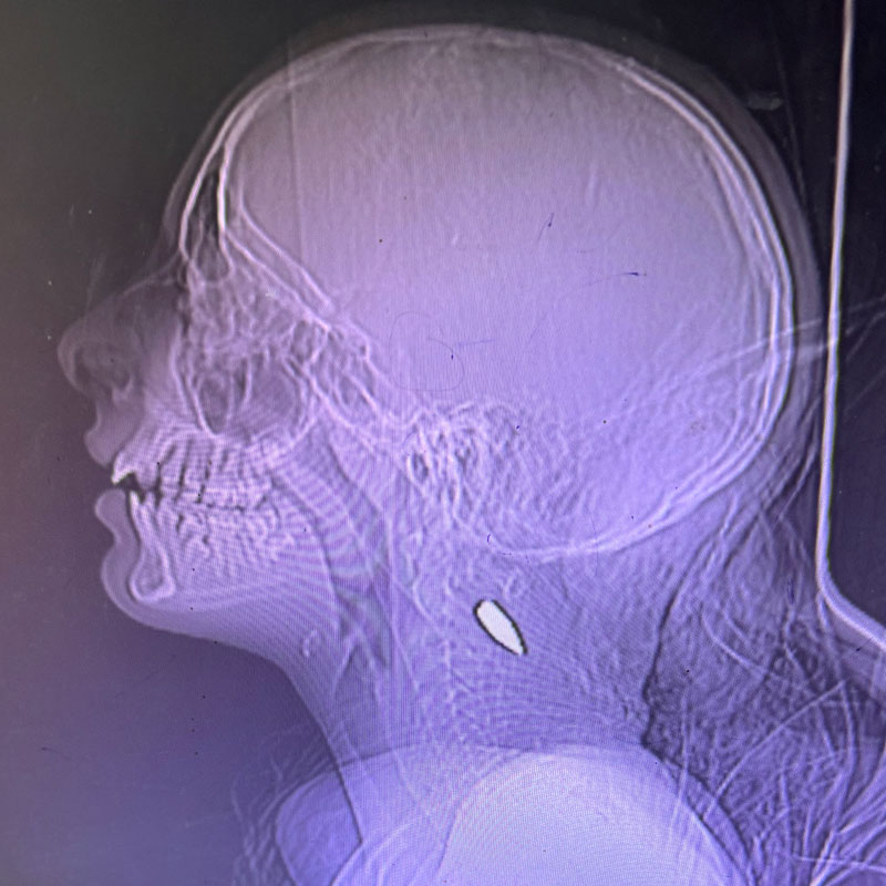 Xray 1