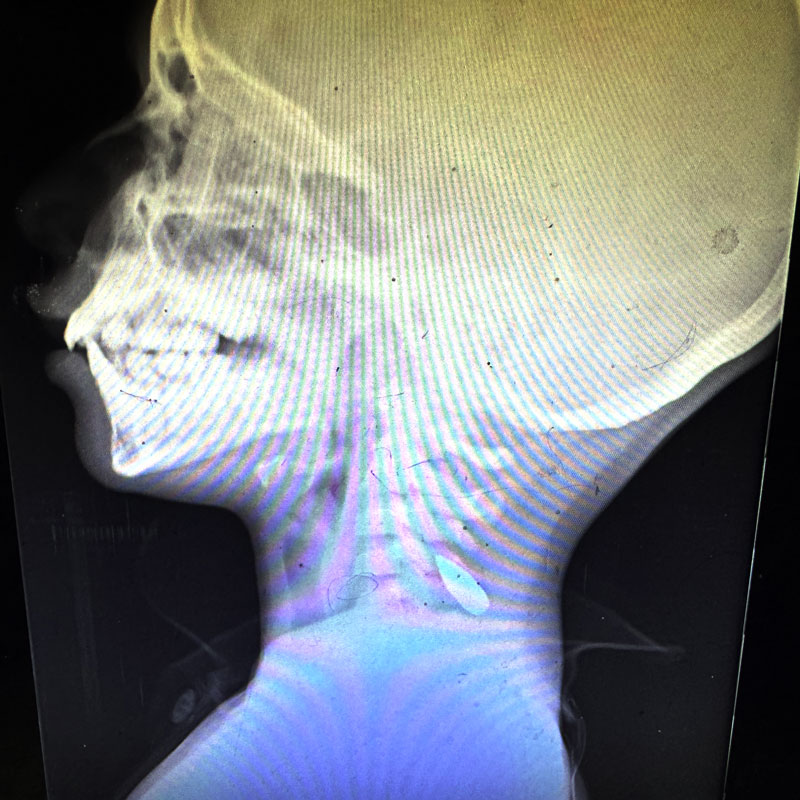 Xray 2