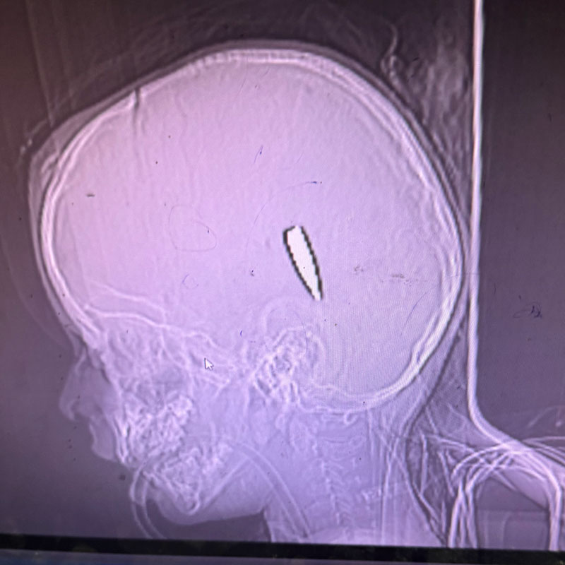 Xray 3